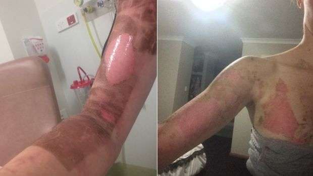 Mother receives second-degree burns in Thermomix explosion | FIVEAA